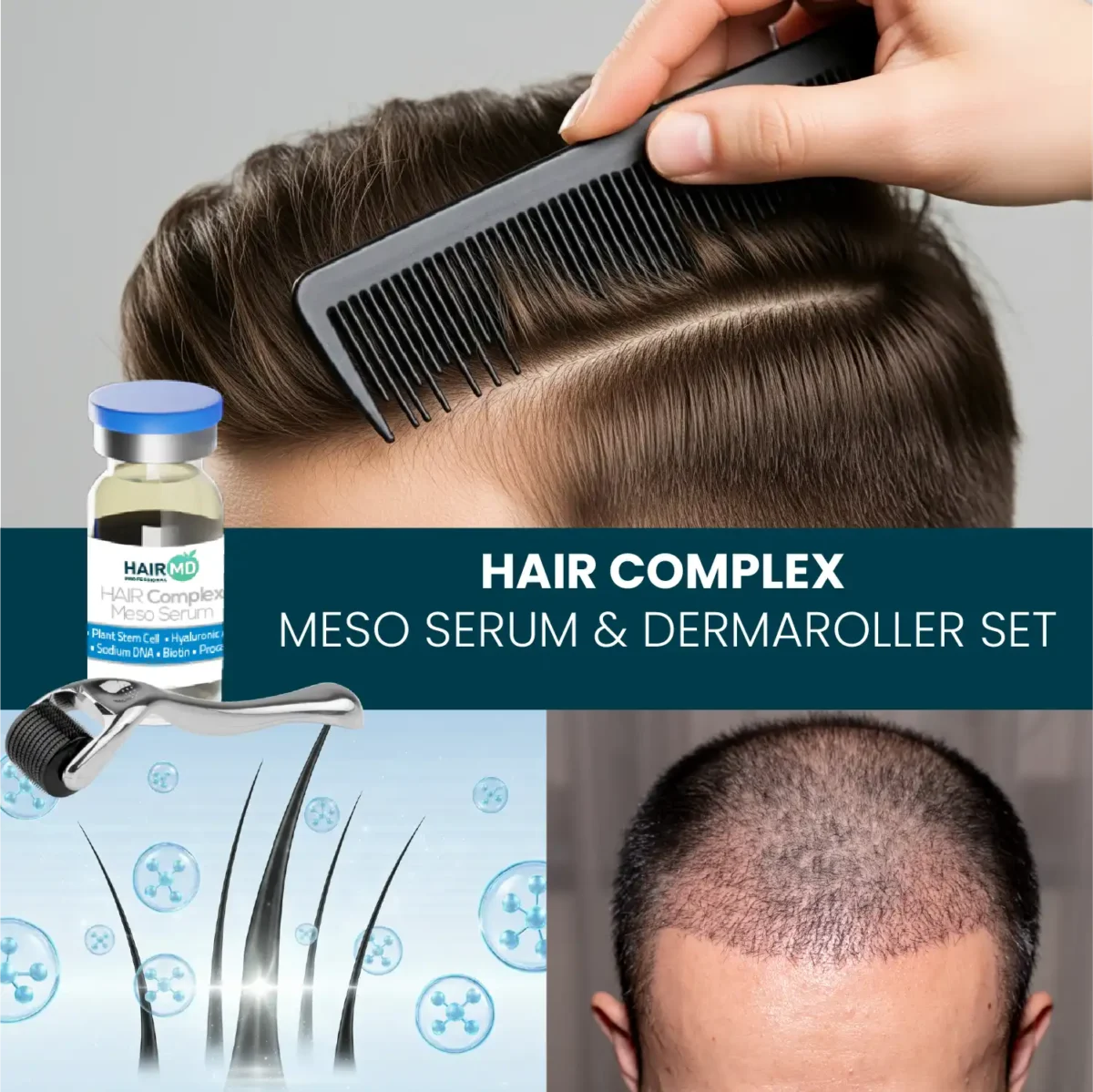 Collage showing combed hair, dermaroller, serum vial and scalp visuals
