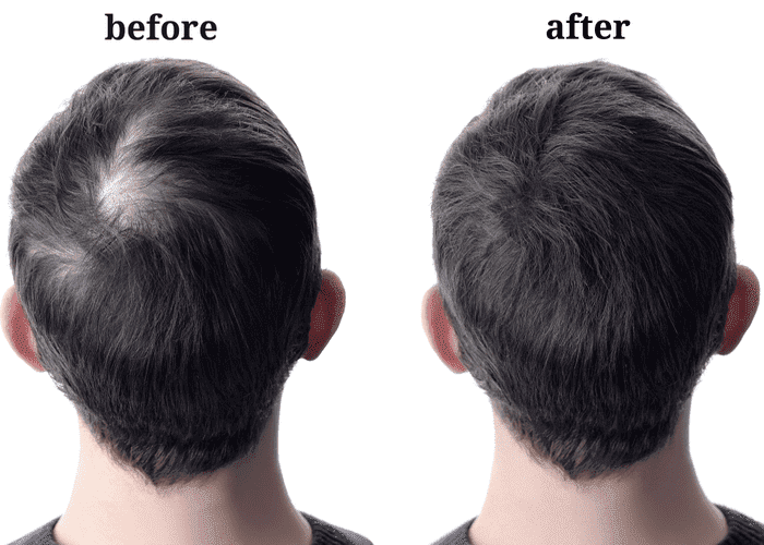 HairMD anti-hair-loss-before-after png 2