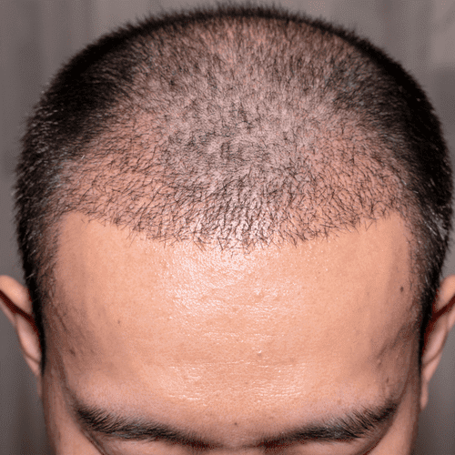 HairMD hair transplant clinical shampoo-serum-tablet -before-after