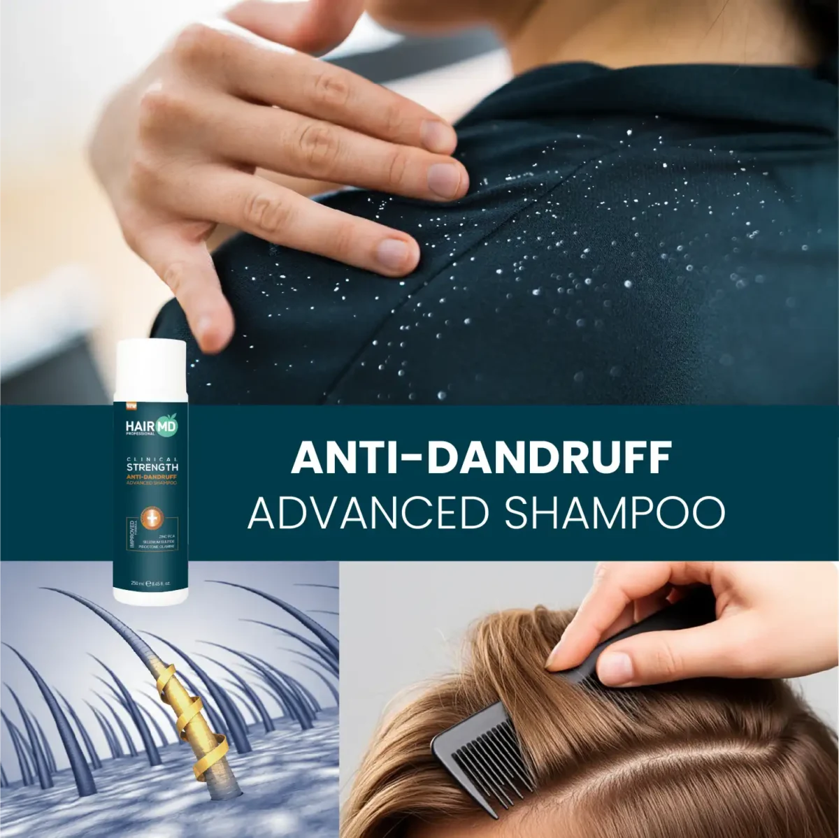 Lifestyle collage with flakes on clothing and HairMD 250 ml anti‑dandruff shampoo