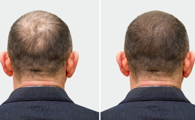 HairMD Professional Hair Density Transformation – Before and After