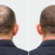 HairMD Professional Hair Density Transformation – Before and After