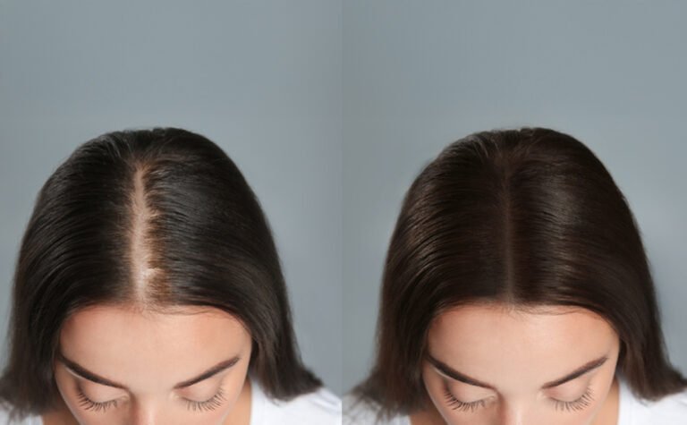 HairMD Hair Density Results – Before and After