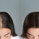 HairMD Hair Density Results – Before and After