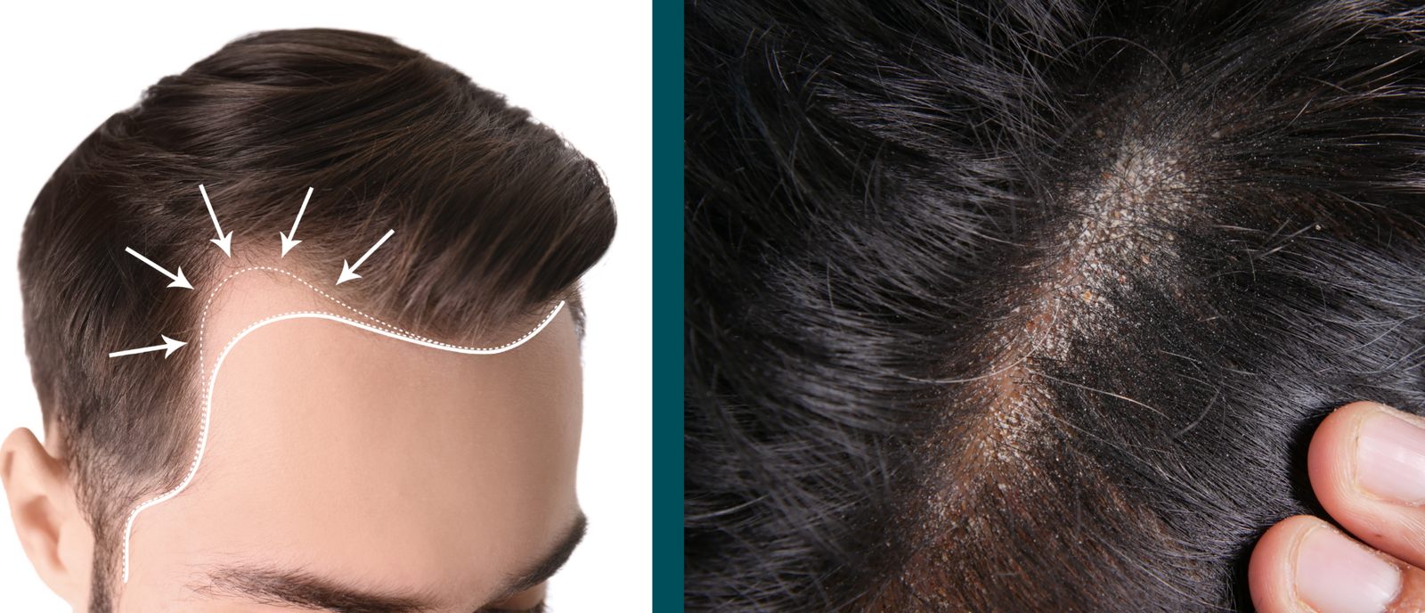 HairMD Preventing Hair Loss
