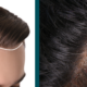 HairMD Preventing Hair Loss