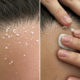 HairMD Provides Renewing Solutions Against Dandruff and Dead Skin