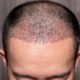 HairMD Products Support Post-Transplant Hair Growth