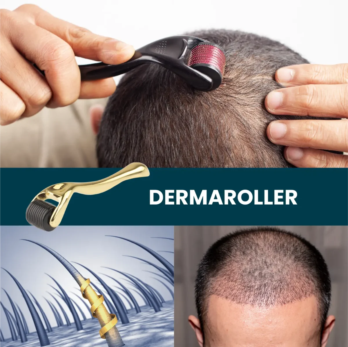 Demonstration of a dermaroller in a hair-care routine with close-up visuals